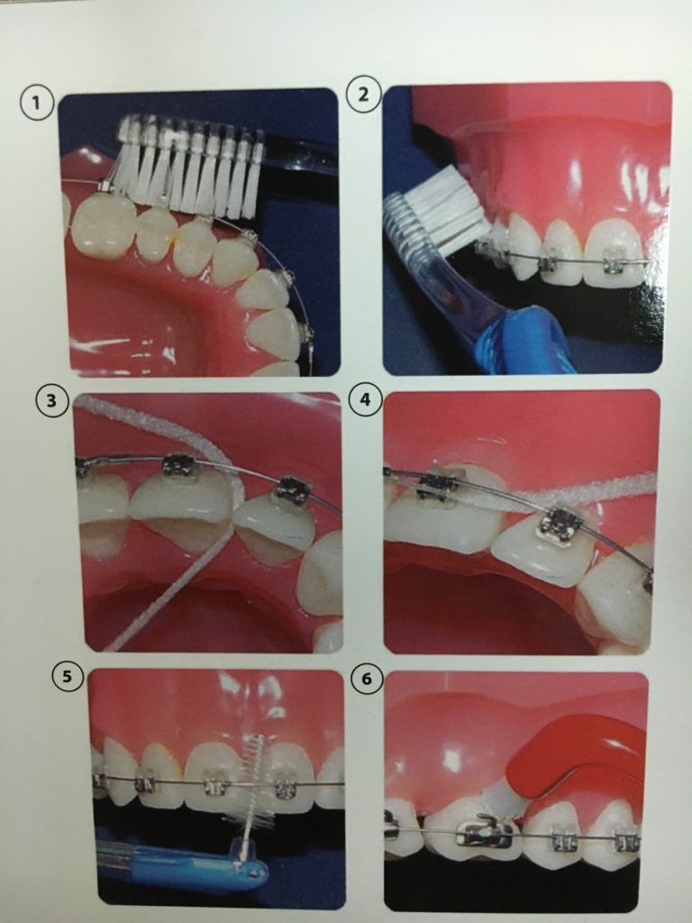 Можно ли делать чистку с брекетами. Профессиональная гигиена с брекет системой. Профессиональная гигиена полости рта с брекетами. Профессиональная гигиена полости рта с брекет системой.