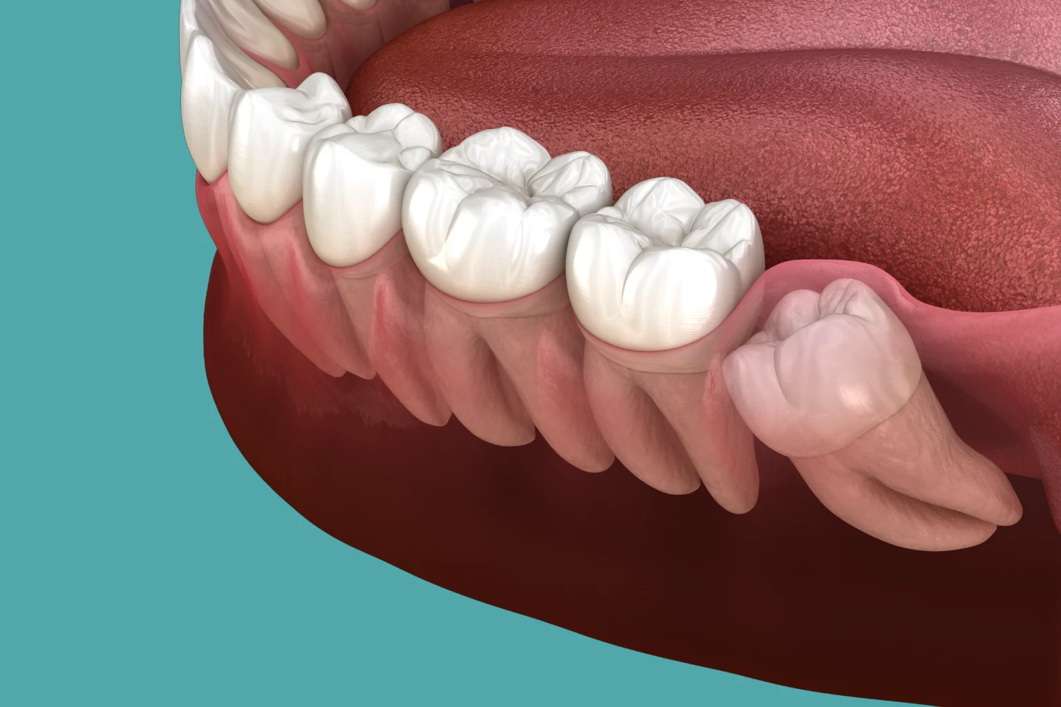 Последствия удаления зуба мудрости - БЛОГ стоматологии УткинЗуб